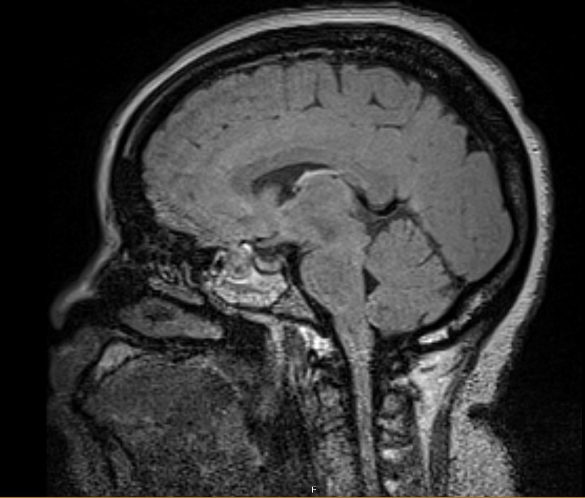 nocturnal epilepsy temporal lobe